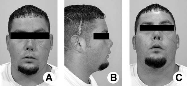 POTTER, DUCIC, AND ELLIS 569 FIGURE 8. Frontal (A), profile (B), and inferior (C) views of patient several months after take-down of the flap and one debulking procedure.