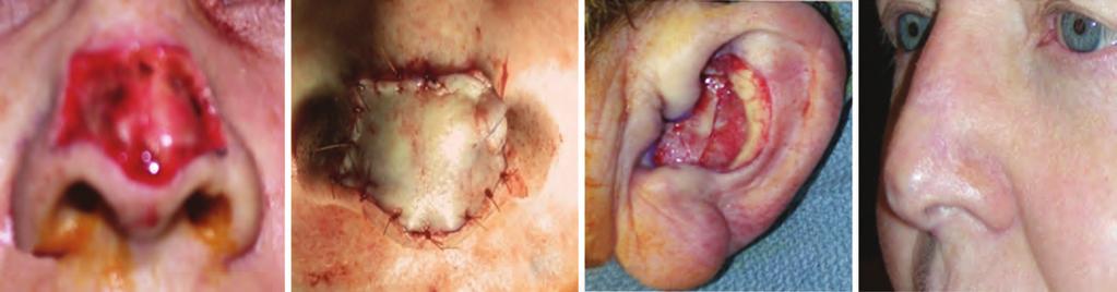 Jamie G Bizzell, Jennings R Boyette apex of the antihelix, antitragus, and inferior crus and continued within the conchal bowl to accommodate the size of the defect.