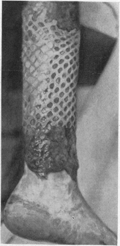 wound following excision of carcinoma on a very fat woman.