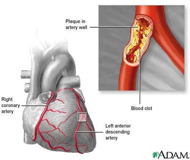 Coronary Heart Disease CHD occurs when plaque buildup occurs in the arteries that supply blood to the heart muscle Possible results: