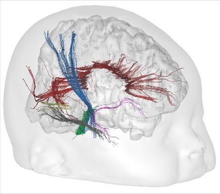 Diffusion tensor imaging of the infant brain: From technical