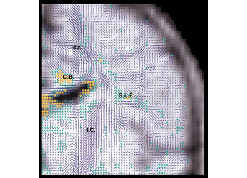 Brain development and diffusion MRI Potential of diffusion MRI