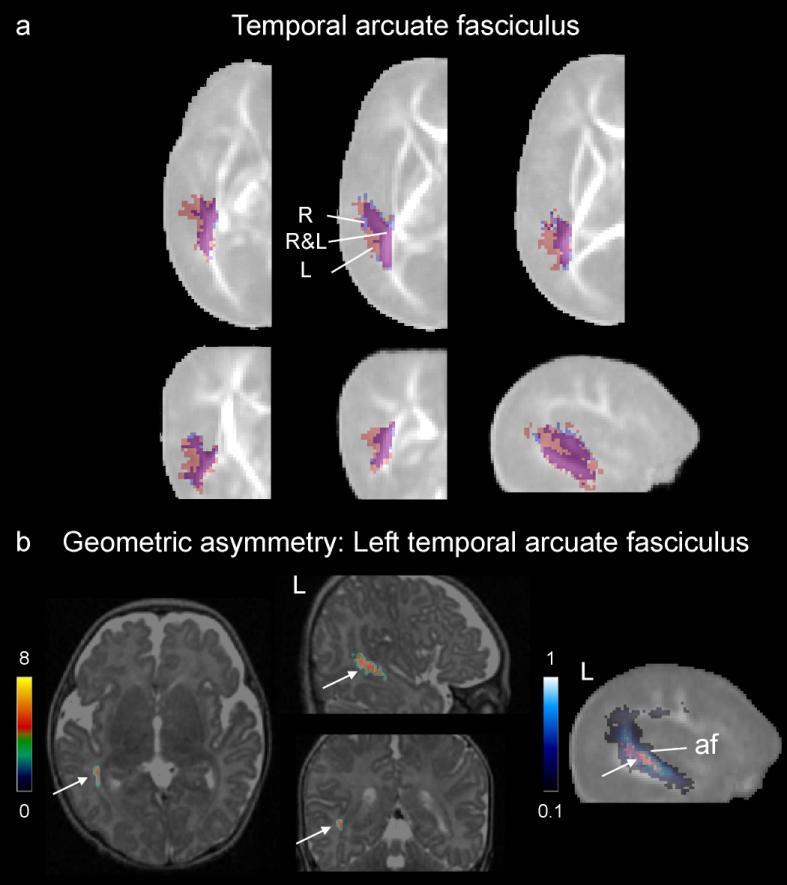 White matter asymmetries in infants Analysis of the fascicles macroscopic geometry The temporal