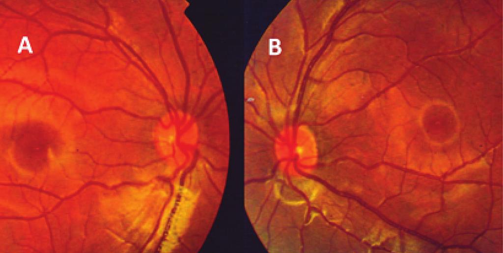 Figure 1. The optic nerve heads of the right (A) and left eyes (B) upon referral. Figure 2.