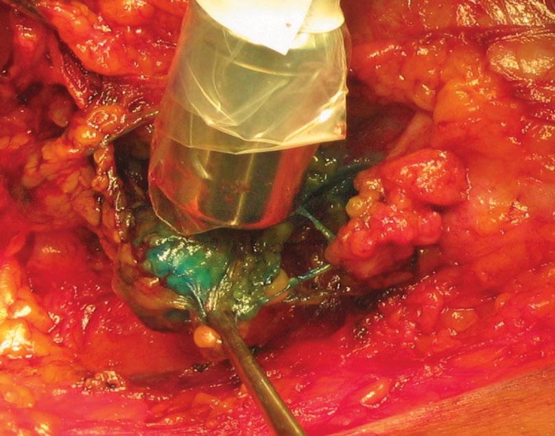 Fig. 4 A blue afferent lymphatic vessel draining into a blue-stained node which is radioactive ( hot ) is the best operative definition of a sentinel node. and anaesthetic for these patients.