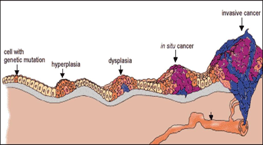 The Stages of Cancer Hyperplasia: proliferation of cells (many cells being produced) Dysplasia: abnormality in maturation of cells, expansion