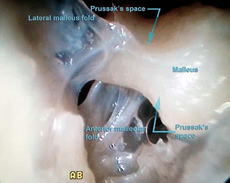 Moreover, the performance of posterior tympanotomy enables one to create an air reservoir in the mastoid widely connected with the tympanic cavity.
