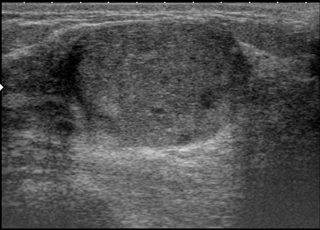 Gland Surgery, Vol 6, No 4 August 2017 413 Figure 1 Ultrasound image of the mass, showing hypoechoic appearances, relatively rounded contours.