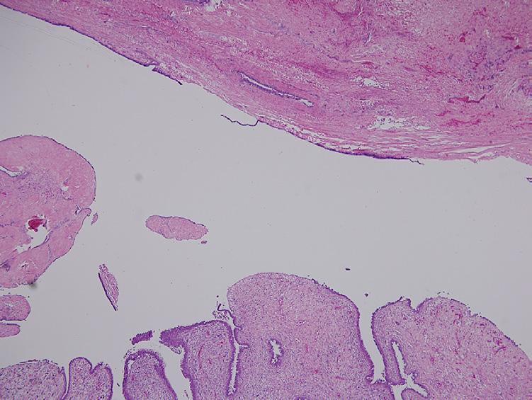 Upper part of the figure indicates the ductal wall; (D) photomicrograph of the tumor showing typical leaf-like architecture of benign component (HE, 40); (E) high power view of a