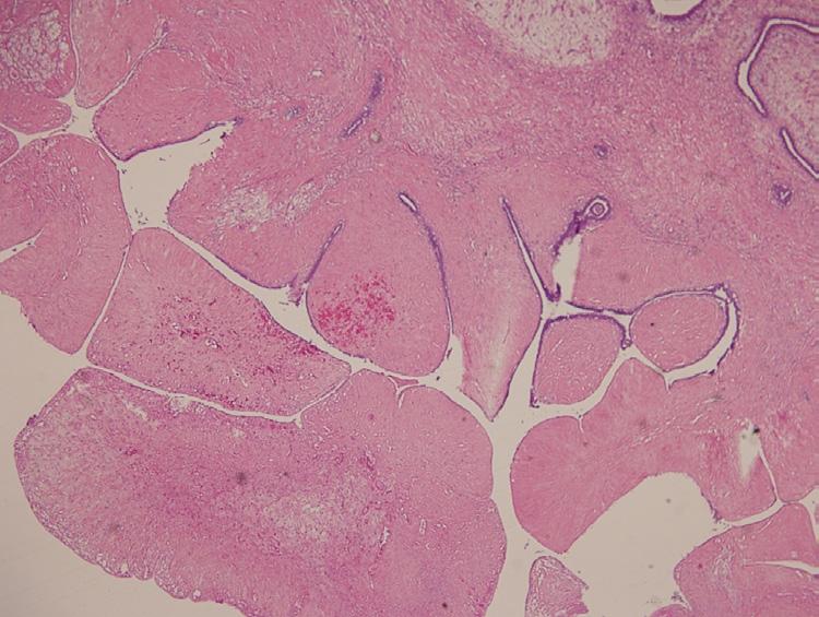200). for her. No axillary lymph node dissection was needed. Immunohistochemical study was applied to this tumor.