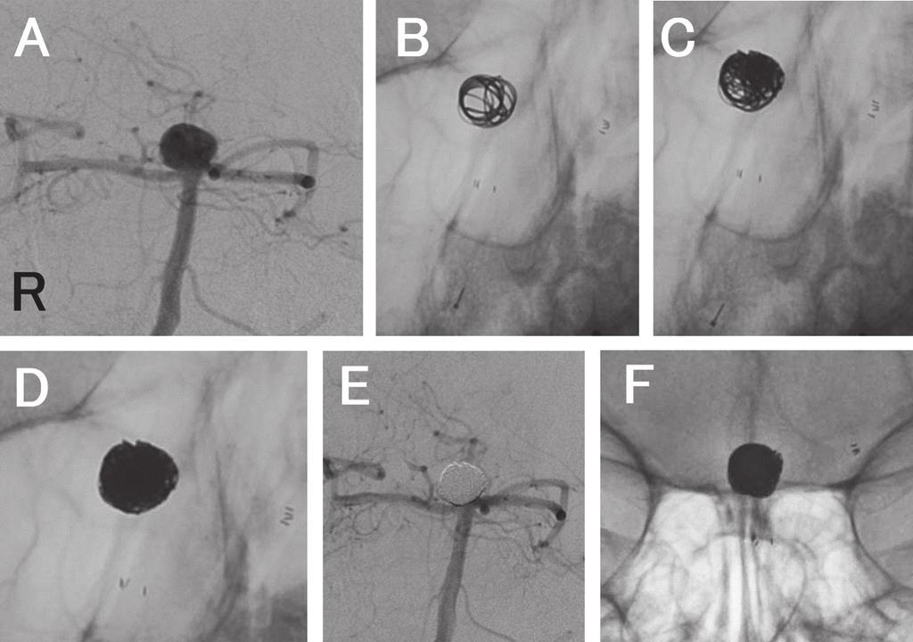 Hemispheric divided coiling 509 Fig. 2 (A) Preoperative digital subtraction angiography showing a basilar apex aneurysm. (B) X-ray image showing deployed stent and a frame.