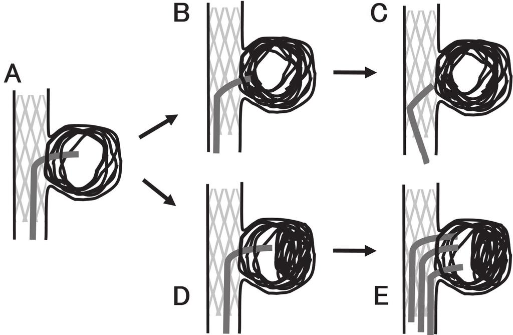 Hemispheric divided coiling 511 Fig. 4 Schematic drawing of stent-assisted coil embolization with the conventional and hemispheric dividing techniques.