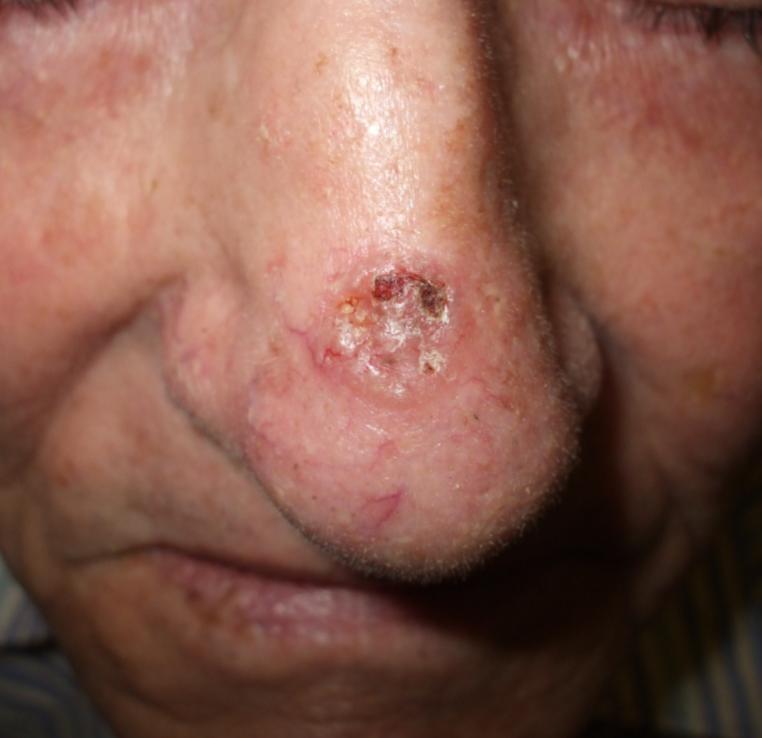 Squamous Cell Carcinoma SCC 2nd most common NMSC Exposure to UV & skin pigmentation Incidence in