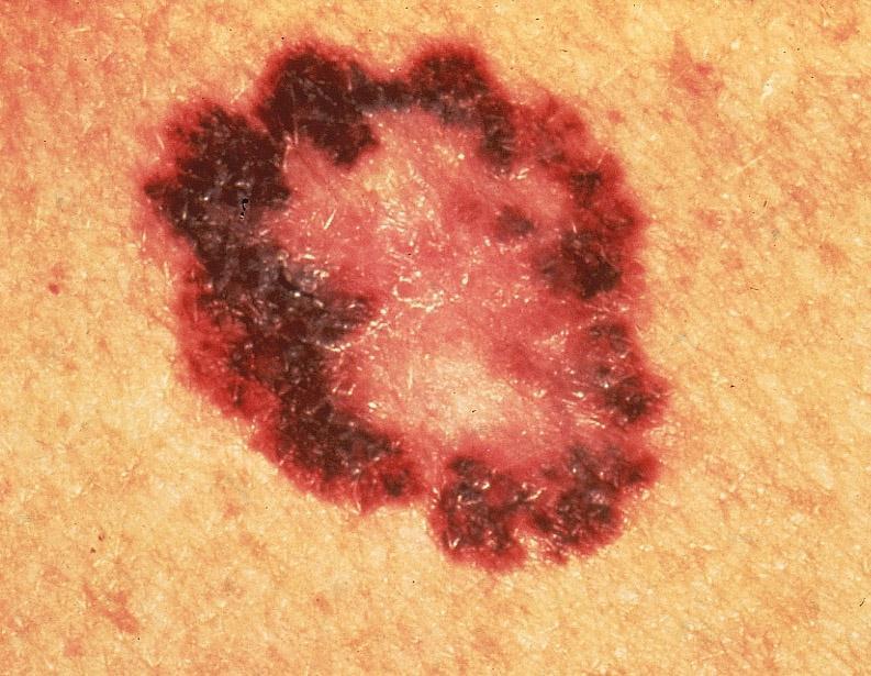 Superficial Spreading Melanoma An endless variety of shapes and sizes can be produced by the random migration of