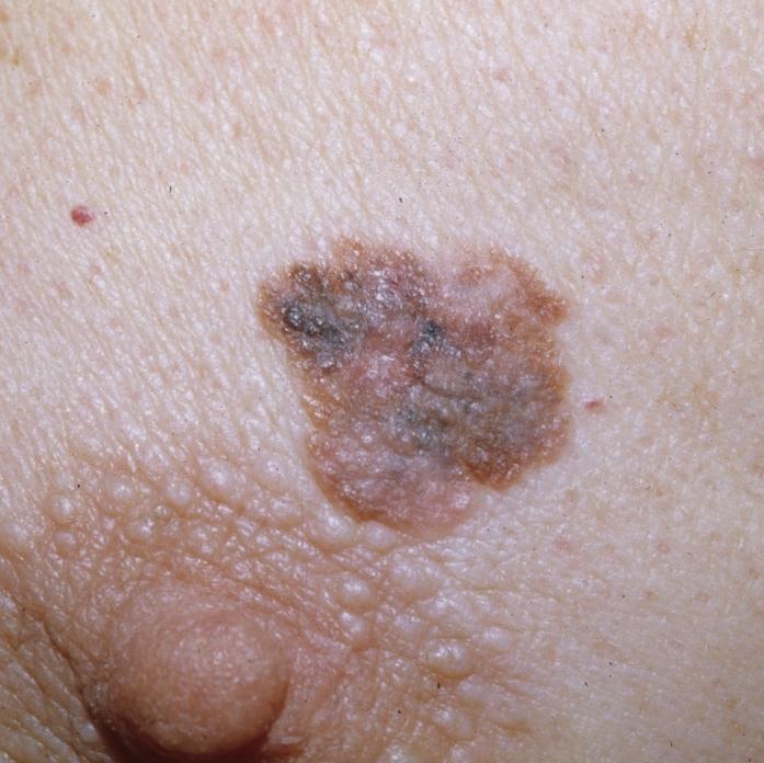 Superficial Spreading Melanoma Diverse colors common, but lesions can be uniformly
