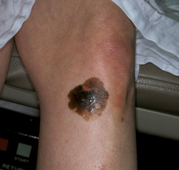 Superficial Spreading Melanoma Most often found in individuals in the 4th-5th decades