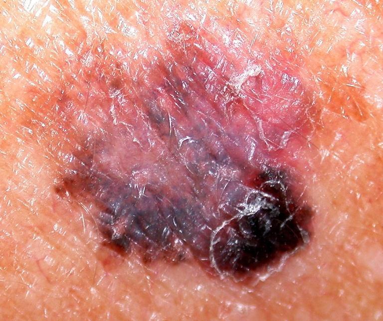 Superficial Spreading Melanoma Often develop nodules (vertical growth) once lesion >2.