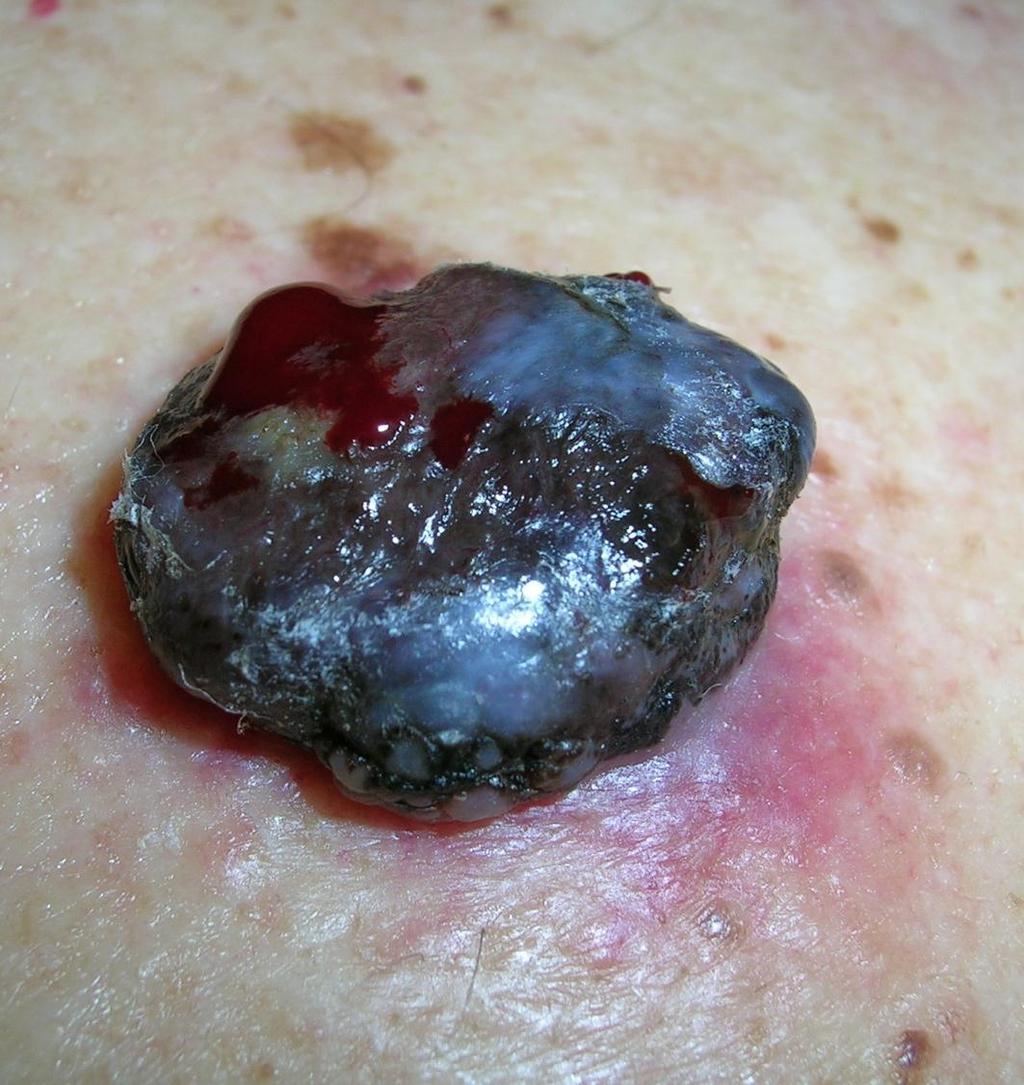 Nodular Melanoma Presents as dome-shaped, polypoid or pedunculated lesion Dark, stuck-on the skin