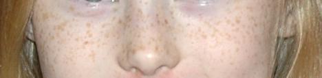 Freckles (Ephelides) Small, 1- to 2-mm, sharply defined macular lesions of uniform color Face, neck, chest, and