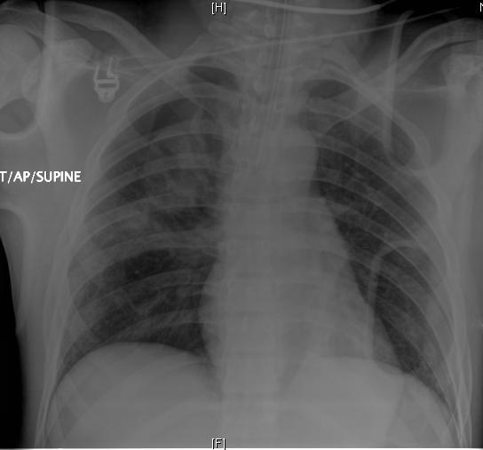 True Case Young year old man Restrained passenger Side impact on his side Intubated in field (mental status)?