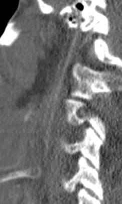 21 carotid canal fractures in 17 patients with 11 ICA injuries in 10