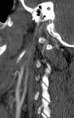 Carotid canal fracture: sensitivity of 60% and specificity of 67% for