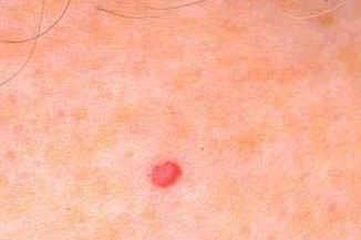 A cherry hemangioma is a benign (non-cancerous) collection of blood vessels that grow right under the skin and make a red bump.