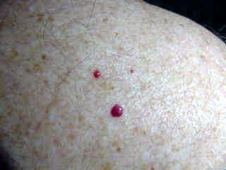 Background: They are the most common cutaneous vascular proliferations. They appear as tiny cherry red papules or macules.
