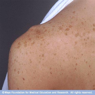 Age spots also called liver spots and solar lentigines are flat gray, brown or black spots.