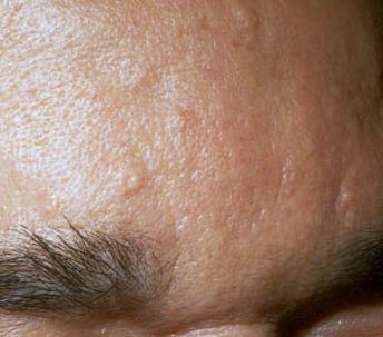 Sebaceous hyperplasia is a common, benign condition of sebaceous glands in adults of middle age or older.