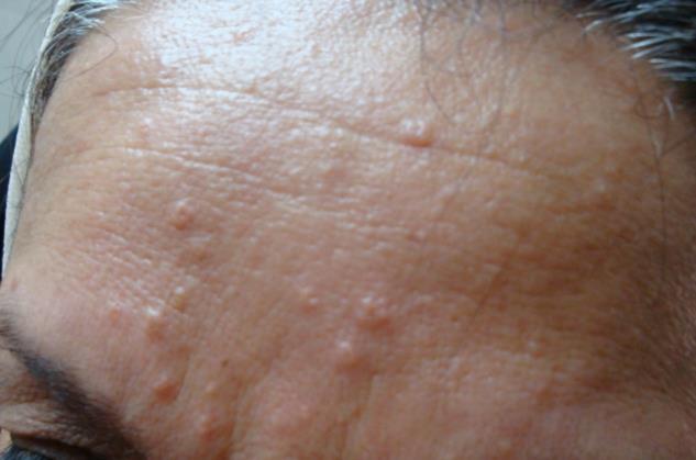 Irritation of the skin by rough sheets or clothing may cause mild reddening around the papule, but the center portion remains white.
