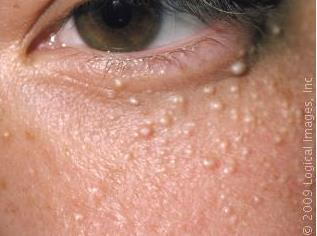 Definition: Milia are superficial inclusion cysts in the skin or mucous membranes.