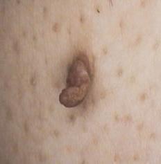 Acrochordons or Cutaneous tags are very common, generally benign skin growths that occur most often after midlife.