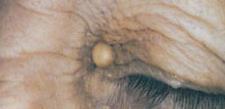 They tend to be yellow, soft and slightly raised bumps and can occur on any area of