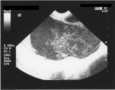 Pelvic U/S useful in the identification of ovarian endometrioma with homogeneous hypoechogenic cystic features and