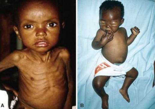 food. Q9. What is Malnutrition? People who do not eat enough food suffer from malnutrition. Malnutrition leads to deficiency diseases.