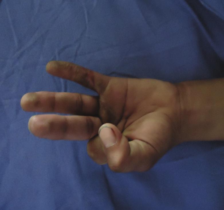 profundus injury in zone II of middle, ring nd little finger of the left hnd Figure 3: Brunner incision mrked suturing method.