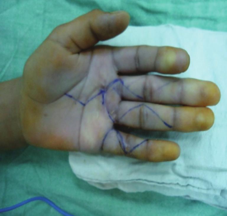 finger in the opposite hnd [Figure 11]. At the end of surgery, it ws ensured tht proximl tendon juncture should glide freely on extension of respective digit.