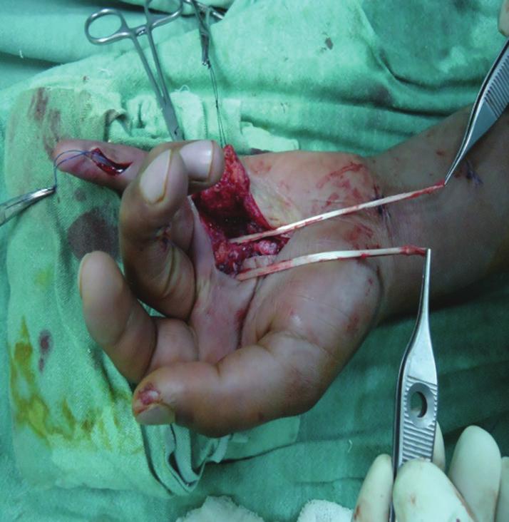 incision Figure 9: Plmris longus tendon grft hrvested