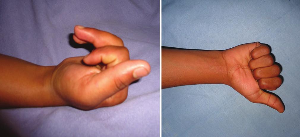 index, middle nd ring finger (efore surgery).