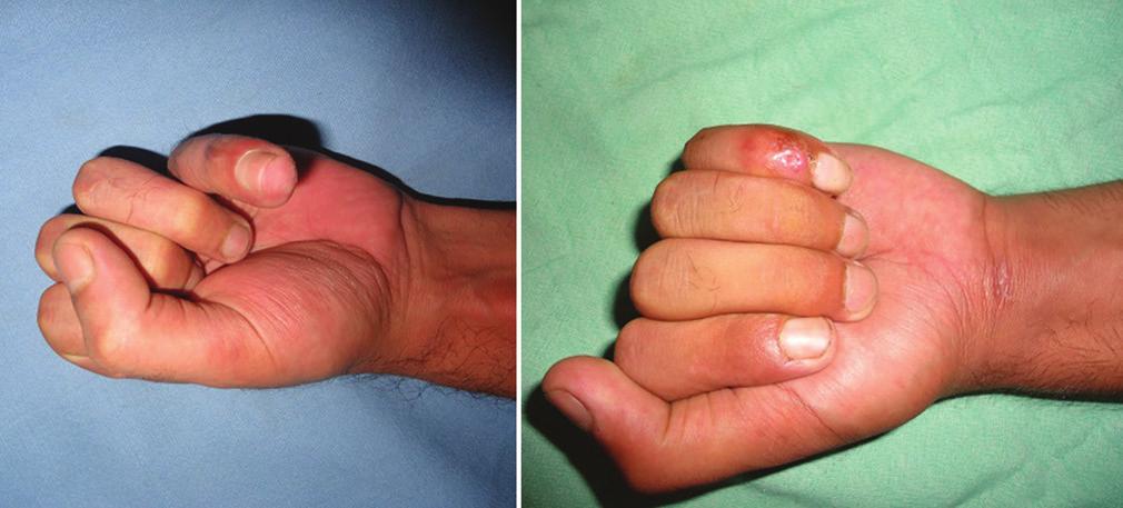 () Ptient with flexor digitorum profundus injury in right middle nd ring finger.