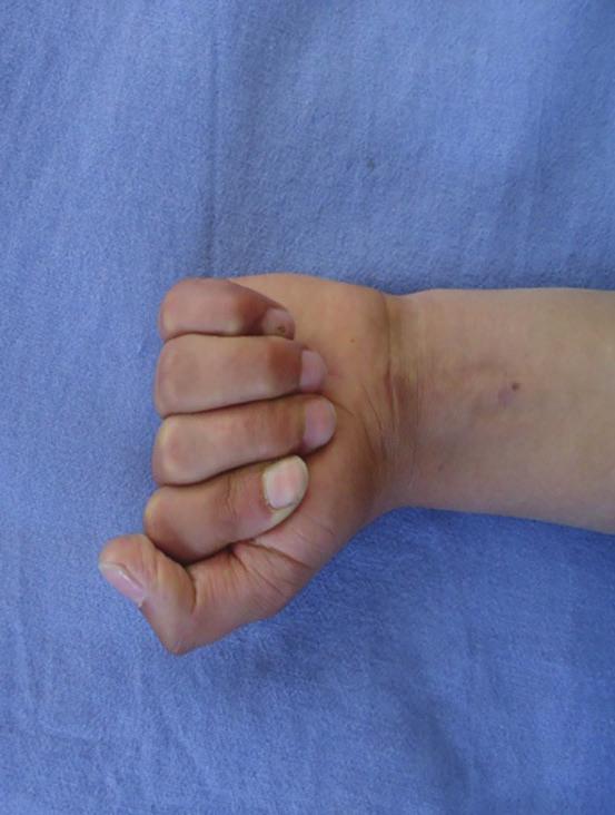 finger (efore surgery).