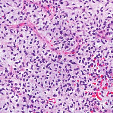 g., spindle cell lipoma, DFSP).
