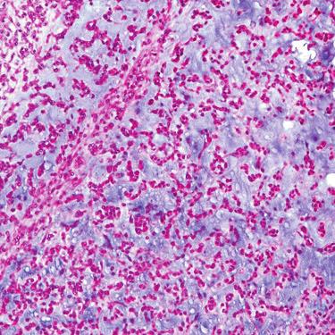 density. These neoplasms are often referred to as small, round, blue cell tumors. Immunohistochemistry is often necessary for diagnosis.