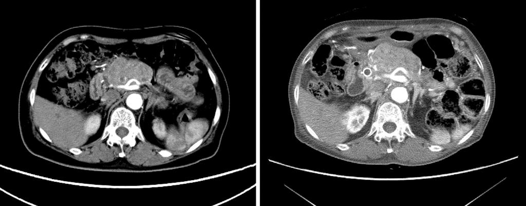 A B Figure 1. Computed tomography of the abdomen. An enhanced pancreatic tumor with metastasis to the para-aortic lymph nodes was demonstrated. A) Beginning of December, 2009.