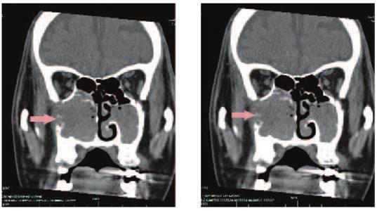 The medial, lateral and anterior walls of the right maxillary sinus had been destroyed by the tumour.