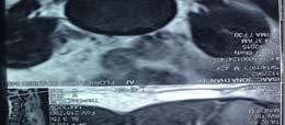 low back pain Left sided L5 Radicular