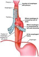 Esophageal foreign bodies Some may easily pass Larger ones may obstruct airway Esophagus narrows in four places 97 Esophageal