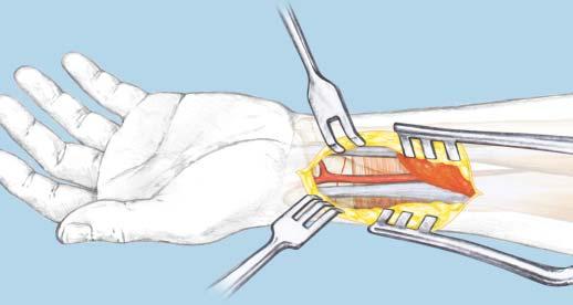 515 Implant Set (stainless steel or titanium) Make a longitudinal incision slightly radial to the flexor carpi radialis tendon (FCR) (Figure 1).