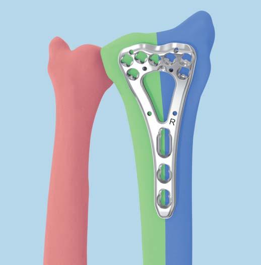 Three-Column Theory The treatment of distal radius fractures requires a meticulous reconstruction of the joint surface, as well as stable internal fixation and early functional postoperative